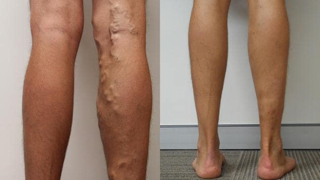 simptomele venelor varicoase ale tratamentului membrelor inferioare piciorul întreg cu varice ce sa faci