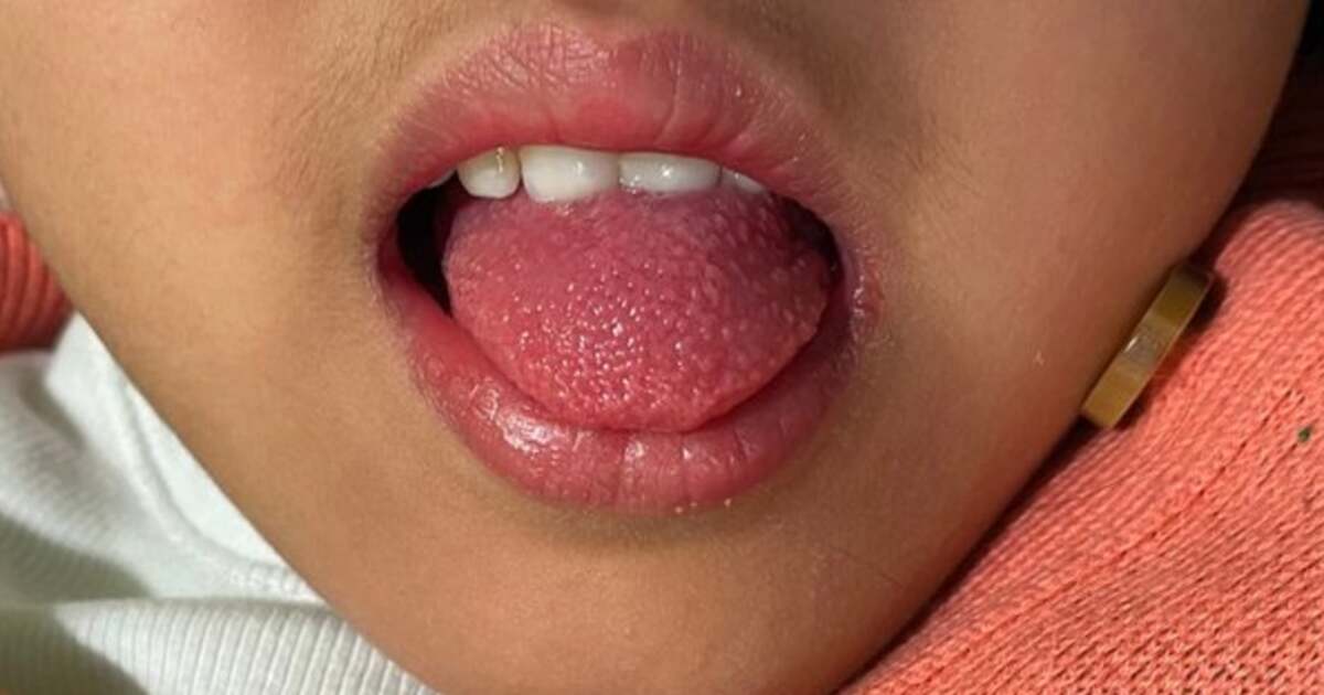 Scarlatina: Cum să prevenim și să tratăm această boală împreună. Scarlatina: Cum să prevenim și să tratăm această boală împreună.