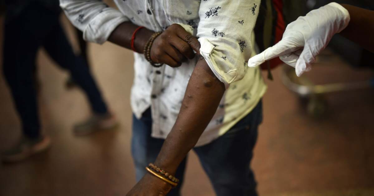 Primul caz de noua tulpină mpox din Europa confirmat Primul caz de noua tulpină mpox din Europa confirmat
