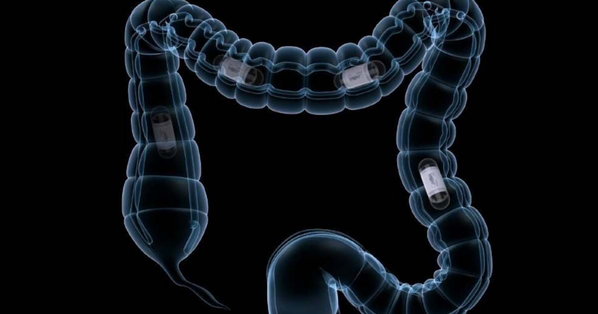 Învățăminte de la Babeș: capsula endoscopică, utilă pentru examinarea intestinului. Învățăminte de la Babeș: capsula endoscopică, utilă pentru examinarea intestinului.