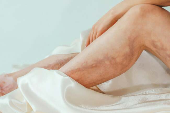 Poza pentru articolul Beneficiile exercițiilor fizice pentru varice – de ce mișcarea este esențială pentru sănătatea venelor?