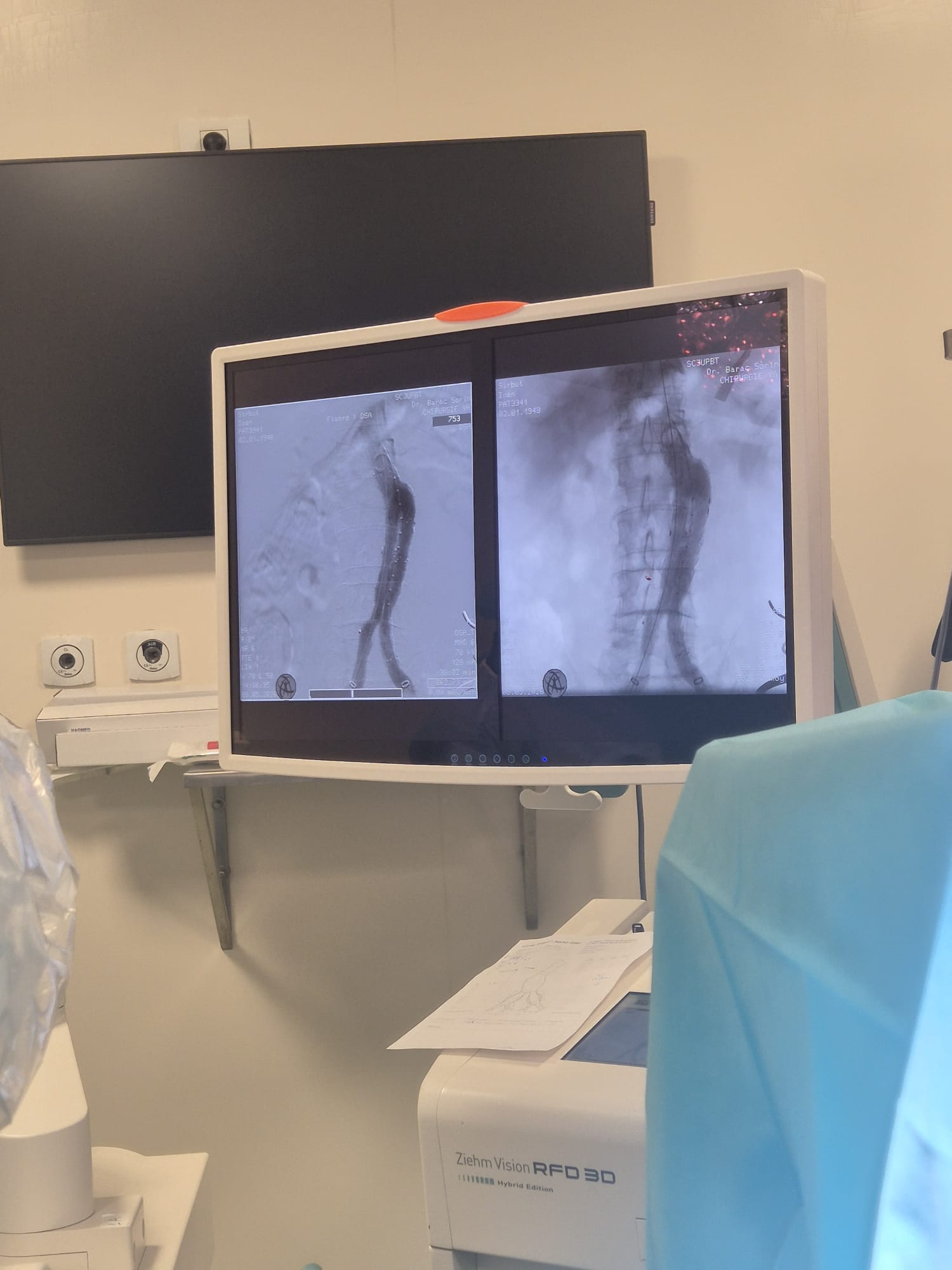 pacient cu anevrism aortic gigant salvat judetean (1)