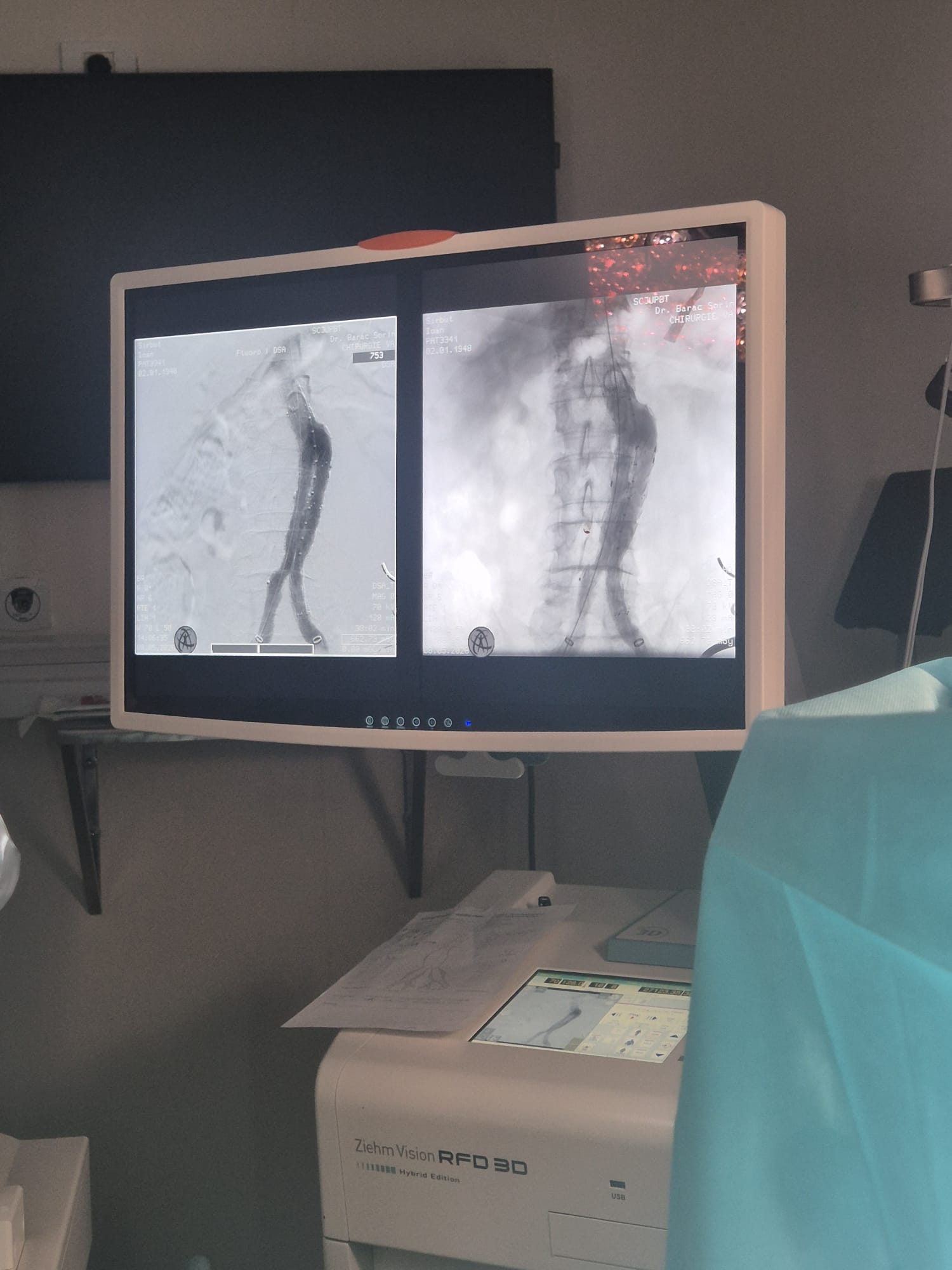 pacient cu anevrism aortic gigant salvat judetean (2)