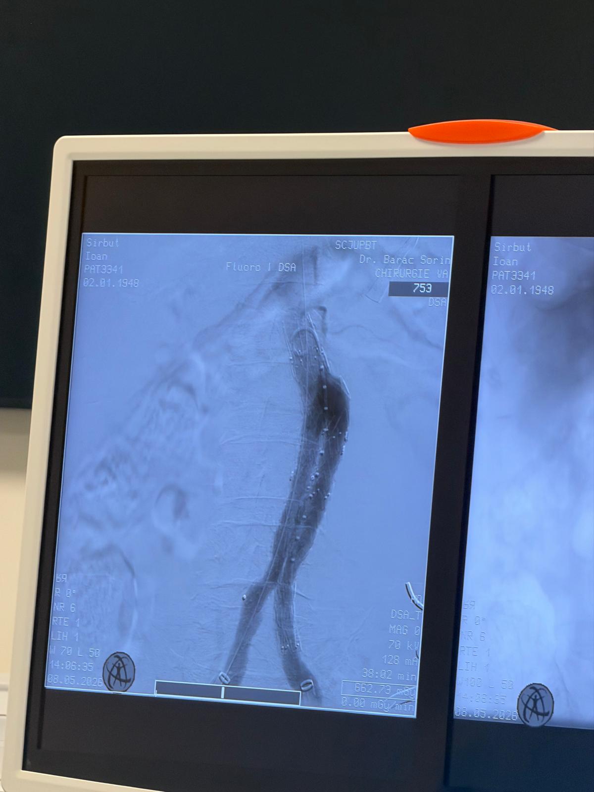 pacient cu anevrism aortic gigant salvat judetean (3)